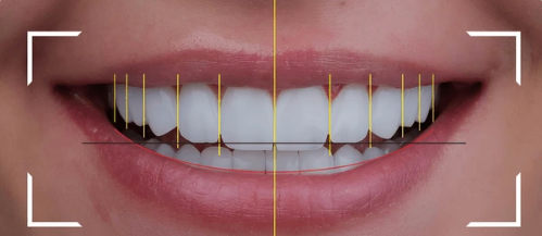 Smile Designing