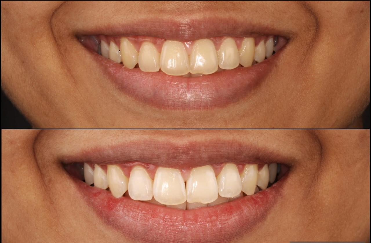 Teeth Whitening