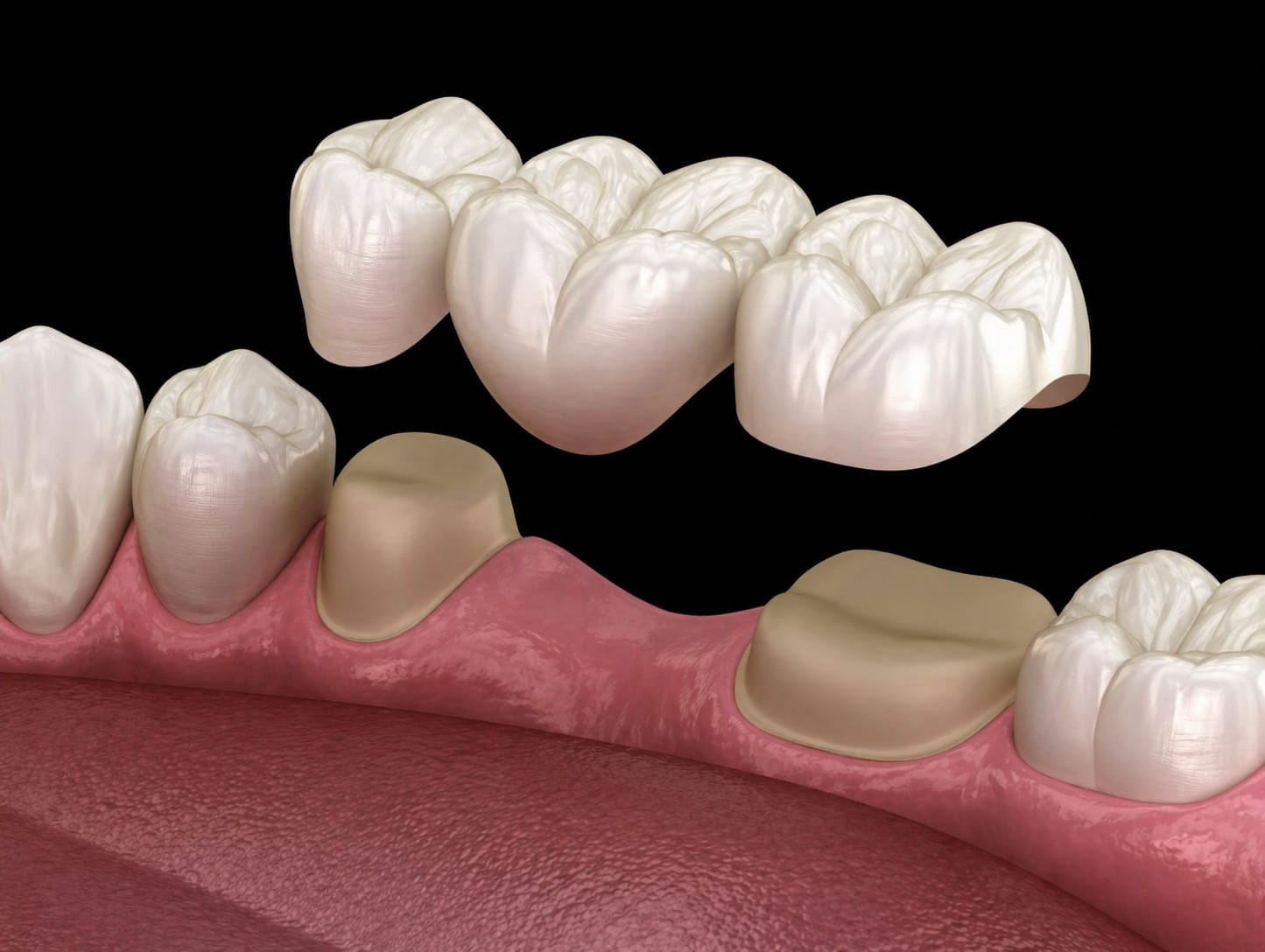 Crowns, Bridges & Veneers