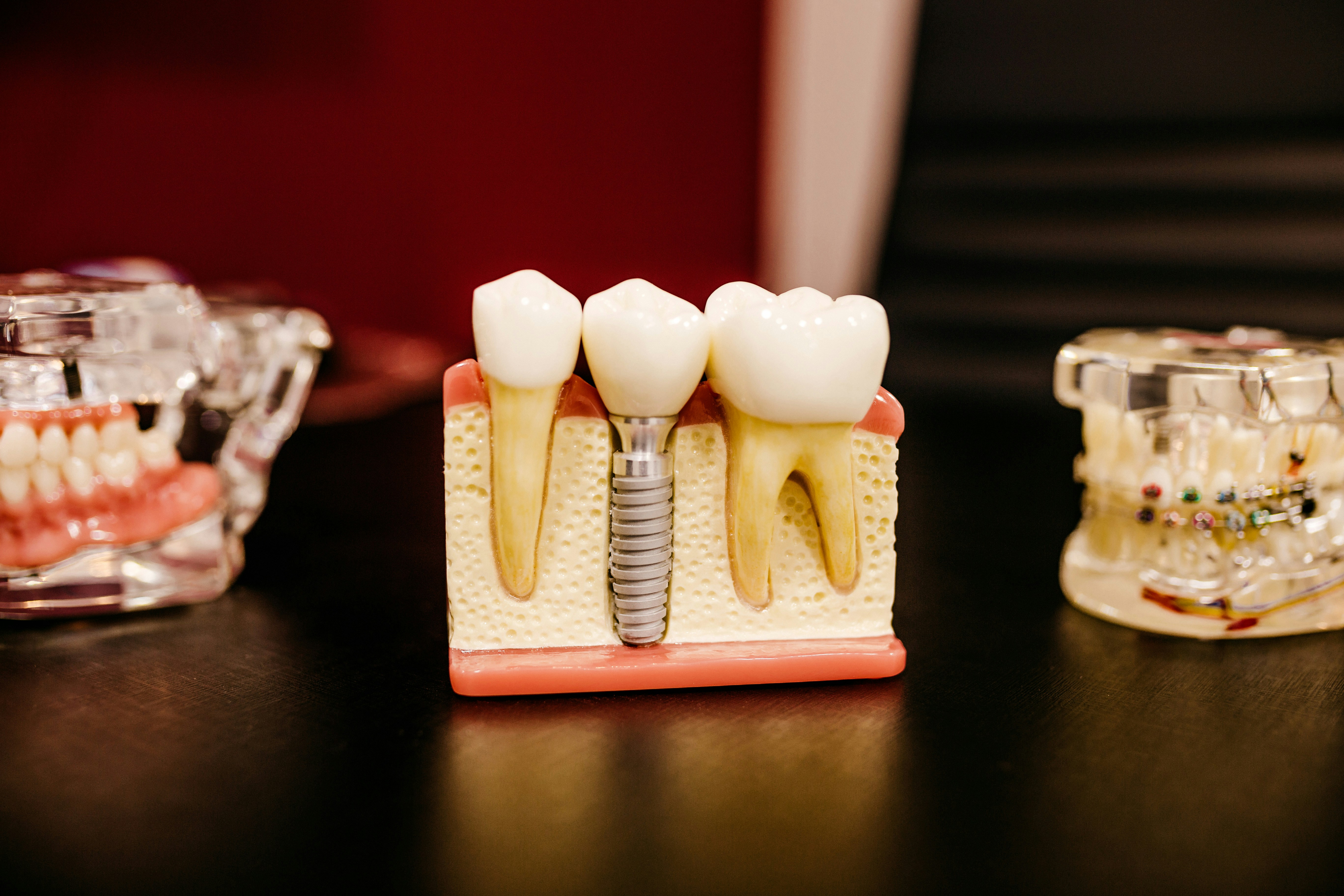 Implants