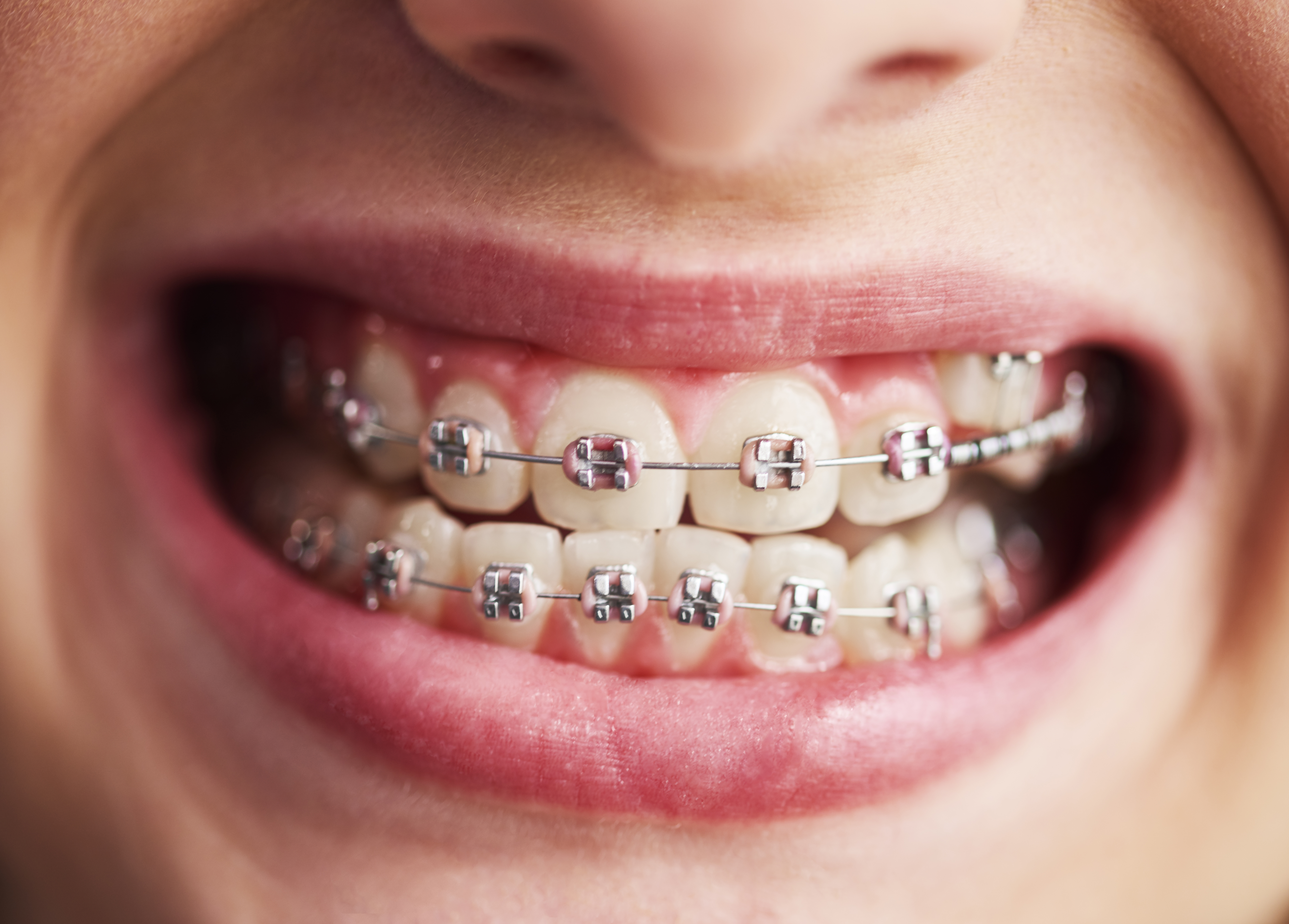 Braces & Invisalign