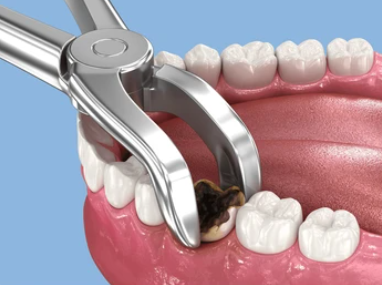 Extractions