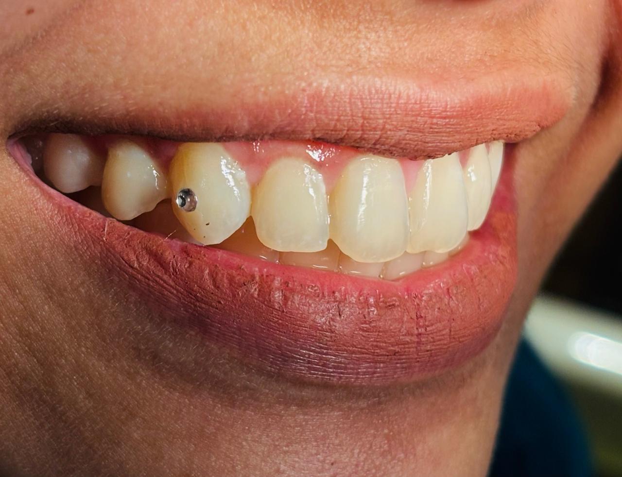 Tooth Jewellery